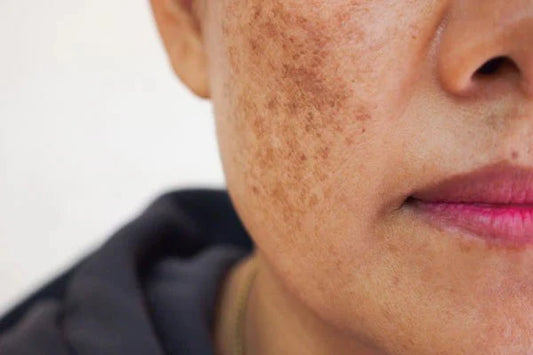 Understanding Dark Skin and Hyperpigmentation: Causes and Treatments - Dr. Rogers-Centers.com